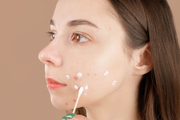 Wat veroorzaakt acne? De belangrijkste oorzaken uitgelegd