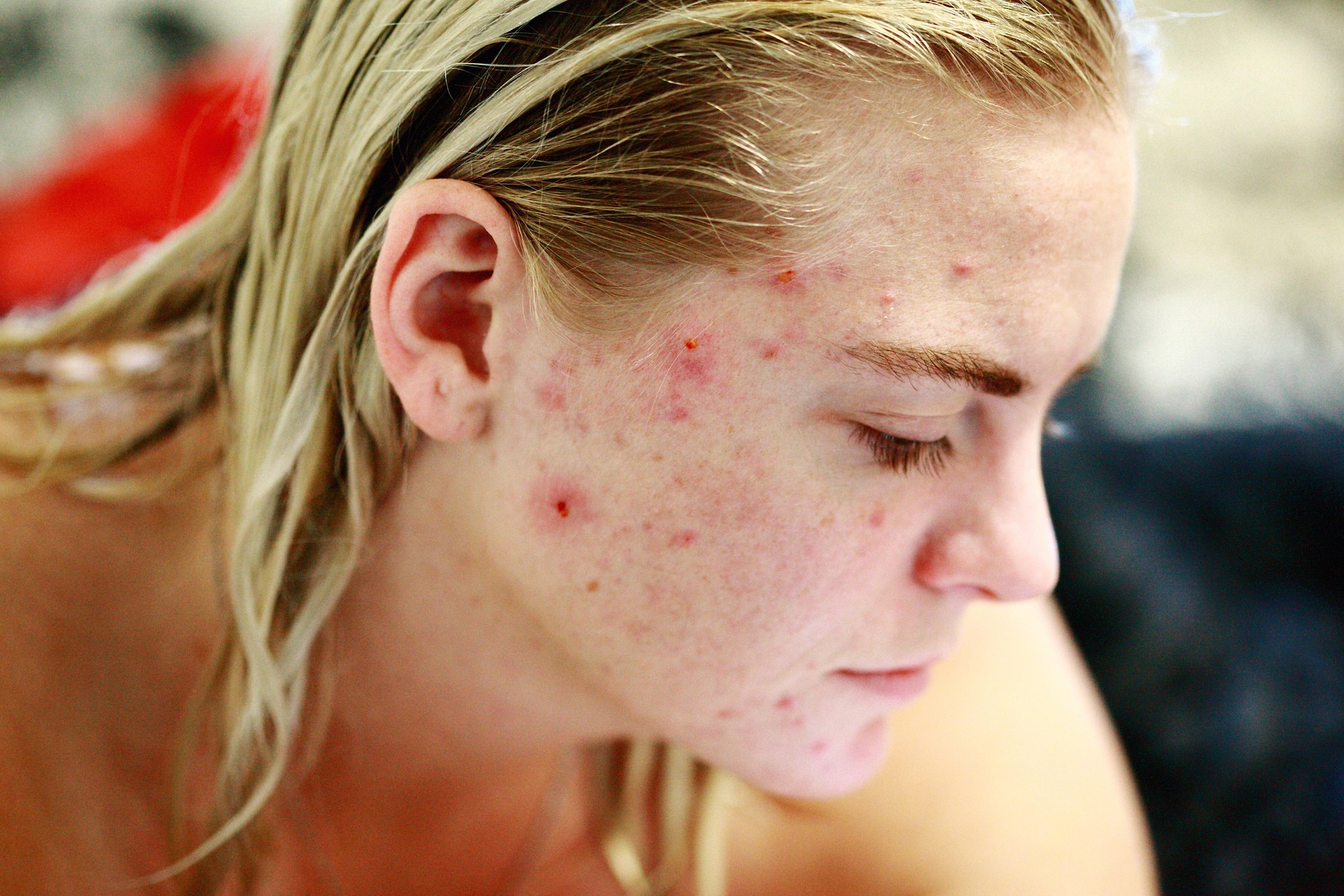 Beste ingrediënten tegen acne: wat helpt echt bij puistjes en mee-eters?