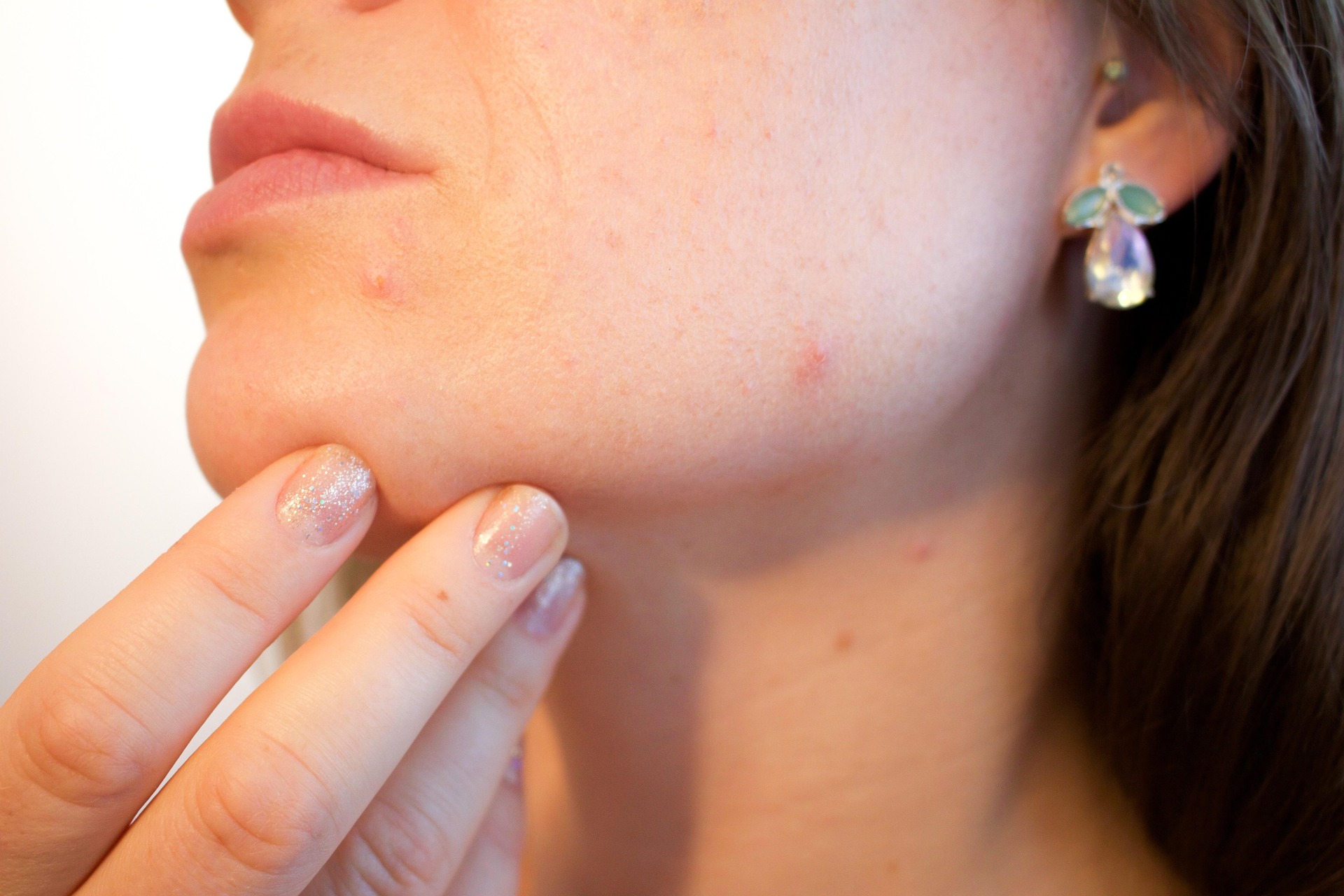 Fouten die acne verergeren: 10 veelgemaakte fouten die je huid onrustiger maken