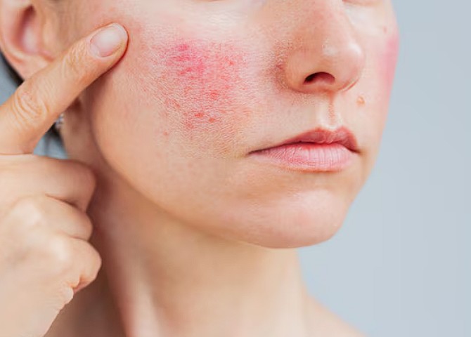 Skincare tips en advies bij gevoelige huid